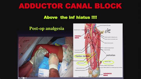 Continuous Adductor Canal Block: After sterile preparation and drapin