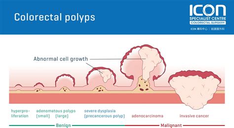 Adenocarcinoma and Polyps