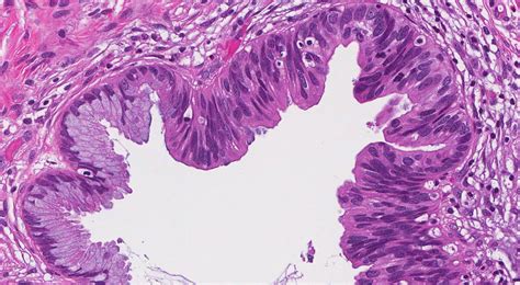 Adenocarcinoma in situ of the cervix: management and outcome.