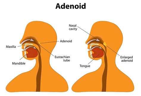 Adenoid enlargement JN