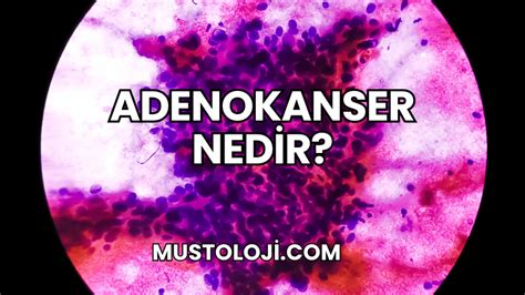 Adenokanser & Belirtileri & Teşhis ve Tedavisi Medicana.