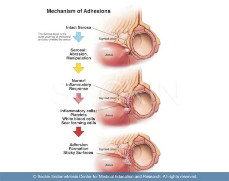 Adhesion Medical Causes and Types