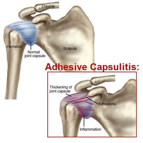 Adhesive Capsulitis in Physical Medicine and Rehabilitation