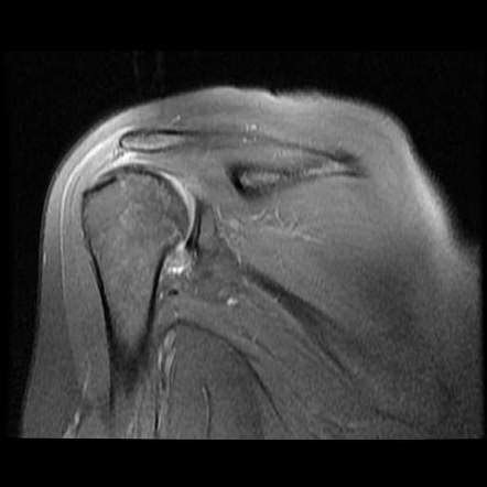 Adhesive capsulitis of the shoulder Radiology Reference Article ...