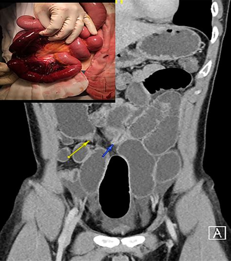 Adhesive small bowel obstruction following abdominal