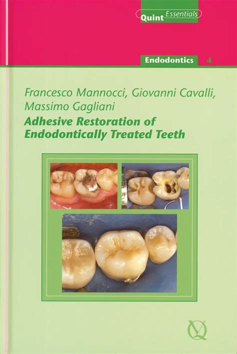Read Online Adhesive Restoration Of Endodontically Treated Teeth Endodontics 4 By Francesco Mannocci