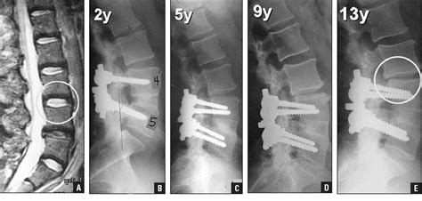 Adjacent Segment Disease Symptoms - Deuk Spine …