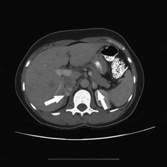 Adrenal pheochromocytoma (Concept Id: C4551683) - National …