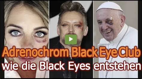 Adrenochrome black eye. Oct 26, 2022 · They claim that the black eyes are the aftermath of injections of a chemical called adrenochrome, which they say is filtered from children's blood and injected into adults to keep them looking young. A third conspiracy theory that has many online believers is that of soul scalping. 