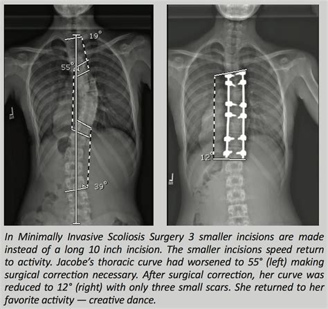 Adult Scoliosis Correction Spinal Corrective Surgery