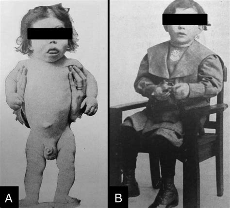 Adult cretinism resulting from cryptothyroidism. - Europe PMC