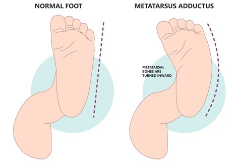 Adult pigeon toed. .  ...