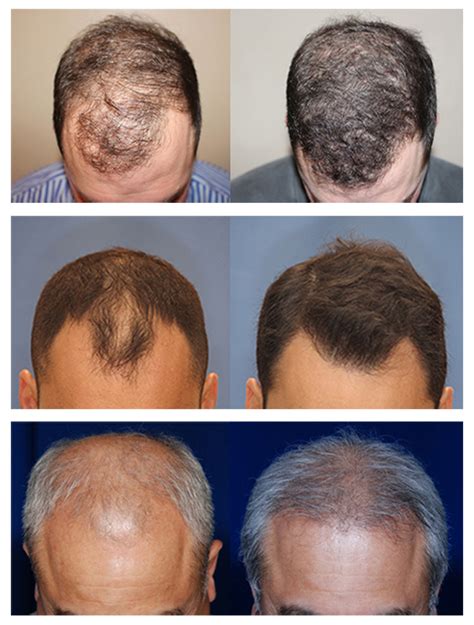 Advanced hair restoration. Things To Know About Advanced hair restoration. 