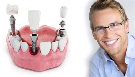 Affordable denture implants. Things To Know About Affordable denture implants. 