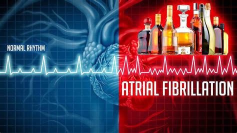 Afib alcohol. Atrial fibrillation (AF) is a common abnormal heart rhythm or arrhythmia. It causes your heart to beat abnormally, which might feel like your heart is fluttering. AF means the top chambers of your heart (the atria) quiver or twitch, which is known as fibrillation. If this happens your heart may beat irregularly, with no set pattern. 