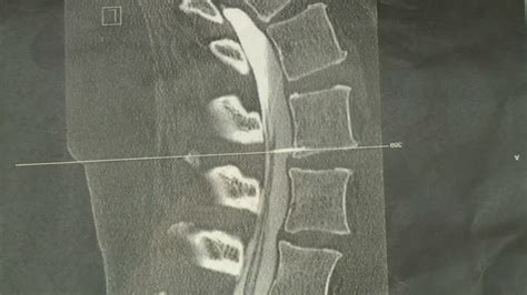 After 20 years, needle in Illinois woman’s spine removed  