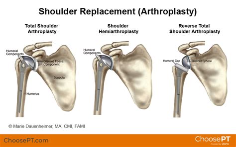 After Shoulder Replacement POST SURGICAL SHOULDER REPLACEMENT REHABILITATION PROTOCOL