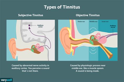 Air Sounds in My Ear Tinnitus Talk Support Forum