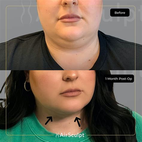 Airsculpt chin before and after. 34 comments. Top. • 8 mo. ago. Ouch! “Abdominal airsculpt” is a term made up by Elite. It’s just laser assisted liposuction, which is just liposuction. It seems inhumane to not use general anesthesia or MAC anesthesia for Tammy and bra roll lipo. Hope you have a quick recovery but that work isn’t a quick recovery. 