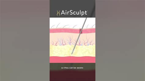 AirSculpt® gives you personalized results