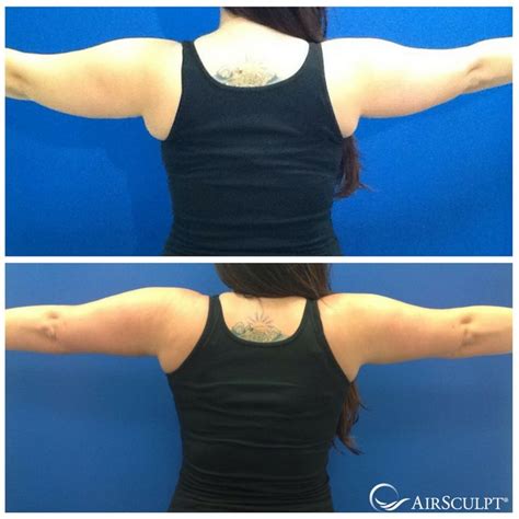 Airsculpting. Pros of AirSculpt. It requires less recovery time than traditional liposuction: about three days as opposed to a week. The hips, abdomen, love handles, arms, back, … 