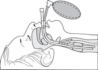 Airways and Airway Management Flashcards Quizlet