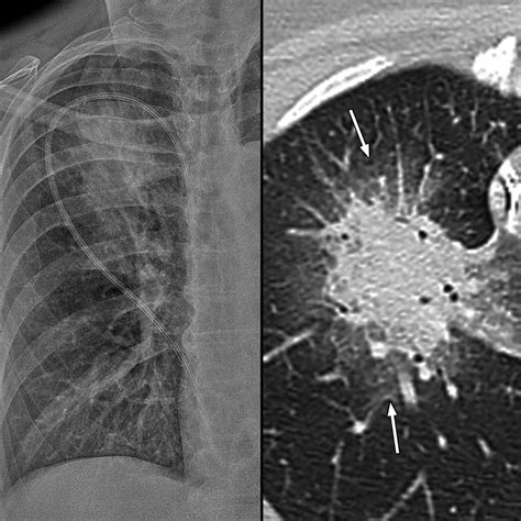 Ajr Imaging Pulmonary Infection