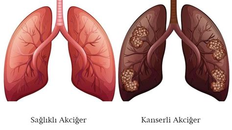 Akciğer kanseri 2 evre yaşam süresi nedir
