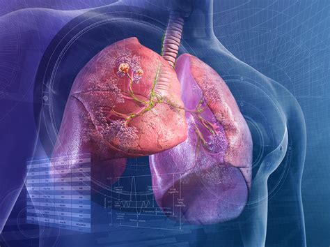 Akciğer kanseri yaş aralığı
