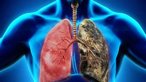 Akciğer kanserinin yaşam süresi