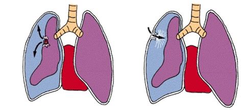 Akciğer patlarsa ne olur