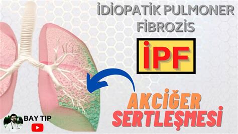 Akciğer sertleşmesi ipf