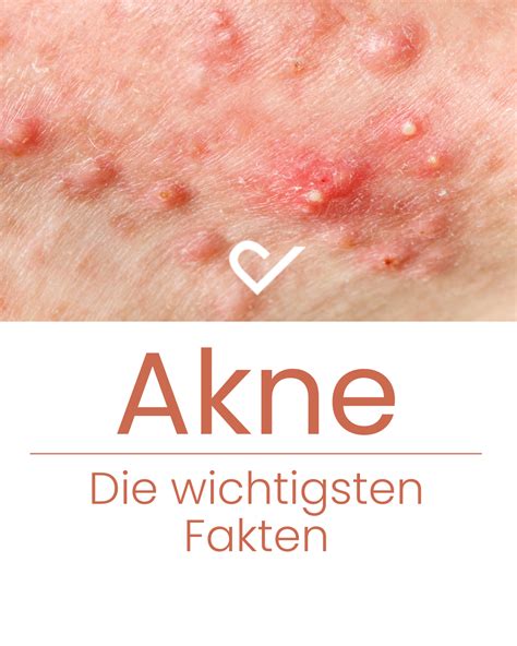 Akne & Siyah Nokta Karşıtı Cream Co.