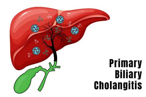 Alan Bonder, MD, on Primary Biliary Cholangitis