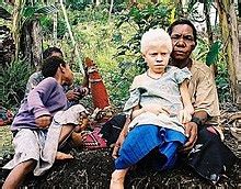 Albinism in humans - Wikipedia