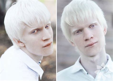Albino nedir