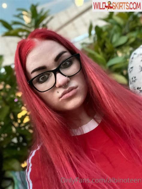 Albinoteen Onlyfans Leak 😈 +18