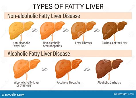 Alcoholic fatty liver disease histology.  Additionally, SLD presents with differe...