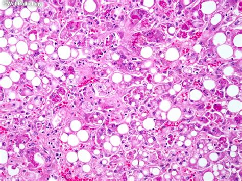 Alcoholic steatohepatitis pathology outlines.  MCV increased.  Although variability in sampli...