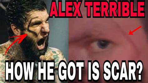 Alex terrible scar. Things To Know About Alex terrible scar. 