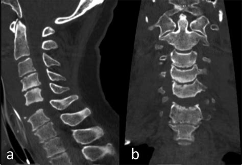 All About Cervical Spine CT Scans With and Without Contrast - WebMD