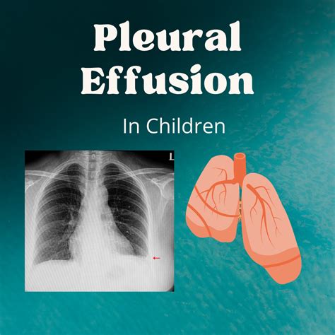 All About Pleural Effusion