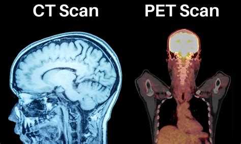 All Ct Scan vs Pet Scan Messages