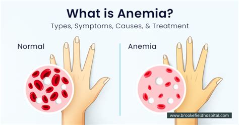 All about anaemia and the diet you need to follow