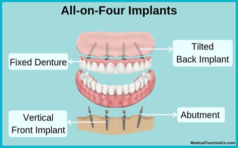 All-on-4 Dental Implants in Mexico Save Up to 70% on US Prices