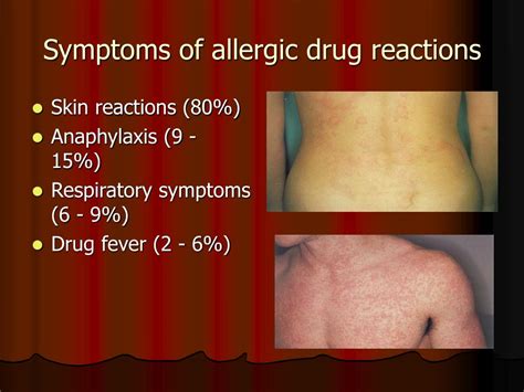 Allergic Drug Reactions