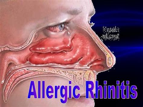 Allergic Rhinitis PPT By Allen
