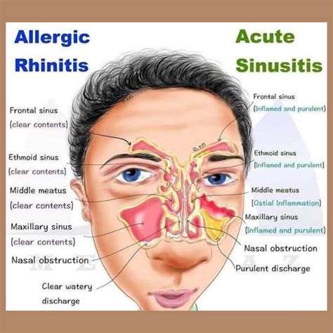 Allergic fungal sinusitis