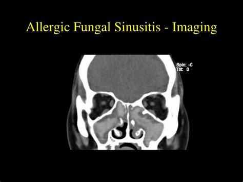 Allergic fungal sinusitis
