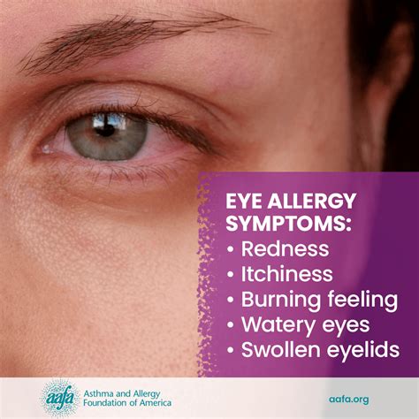 Dust allergy symptoms include: Sneezing; Runny or stuffy nose; Red, itchy, and watery eyes; Itchy skin; Wheezing, coughing, shortness of breath; Food allergysymptoms. 